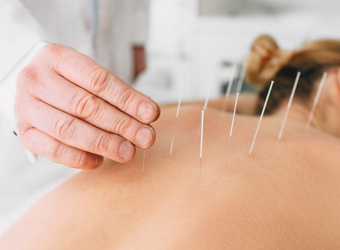 Acupuncture