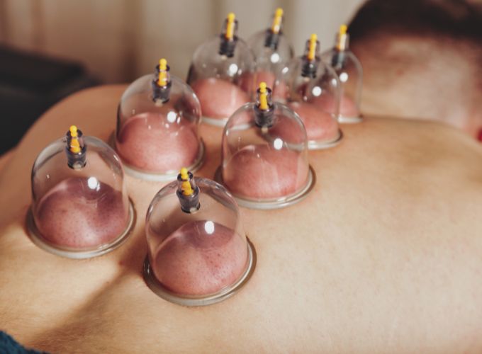 Cupping